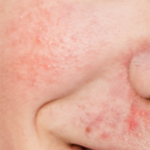 Facial Blemishes